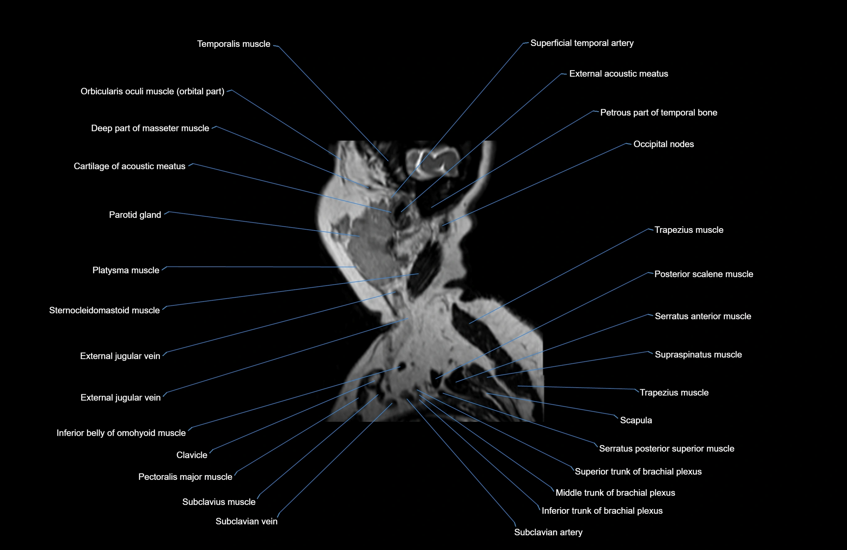 Neck MRI sagittal cross sectional anatomy 3D 1mm 3T radiology  image-img-00001-00038.webp